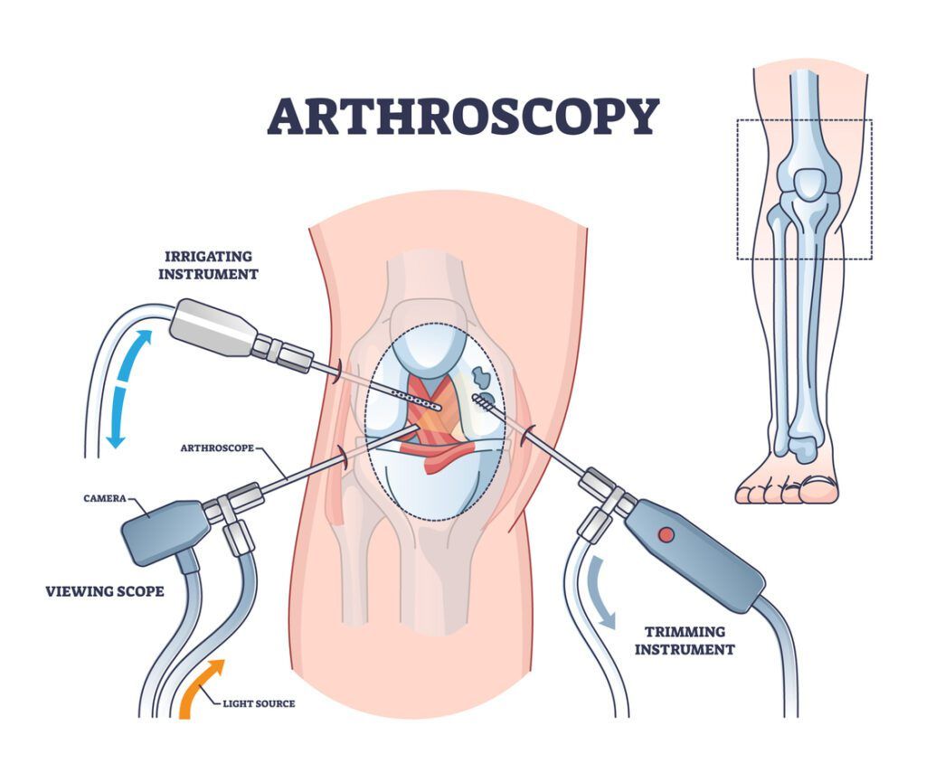 Arthroscopy illustration