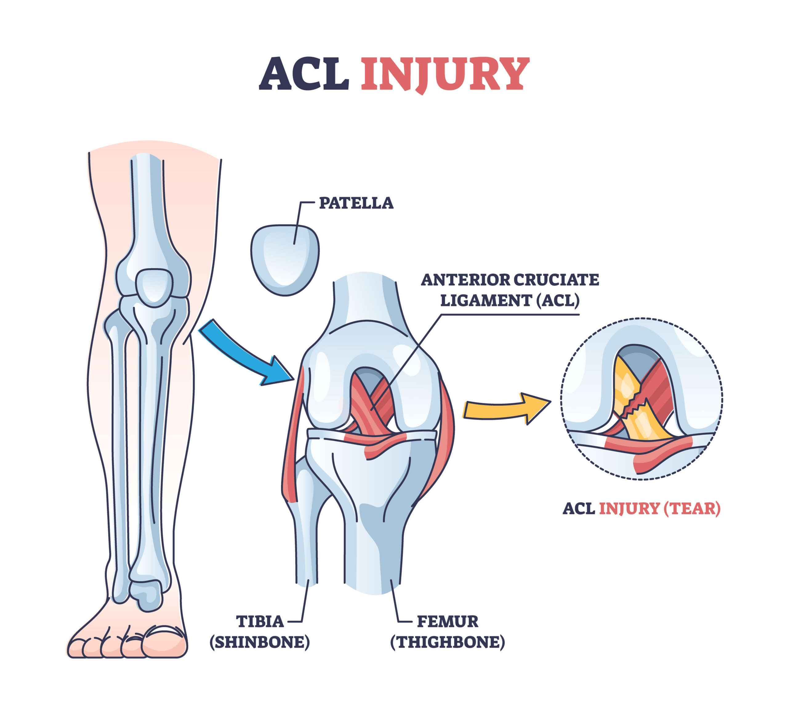 Anterior Cruciate Ligament Repair