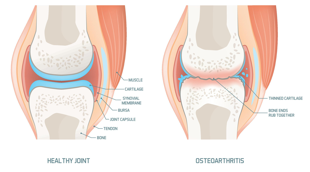 Total Knee Replacement Surgeon in Noida