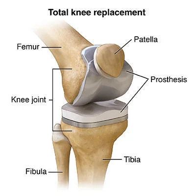 Unicompartmental vs Total Knee Replacement